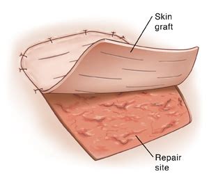 Chirurgie de greffe de peau | be settled