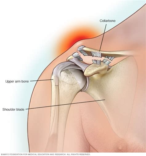 Separated shoulder - Mayo Clinic