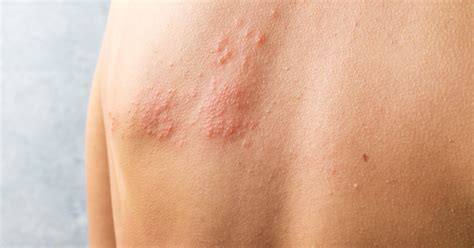 5 Facts About Shingles | RUSH