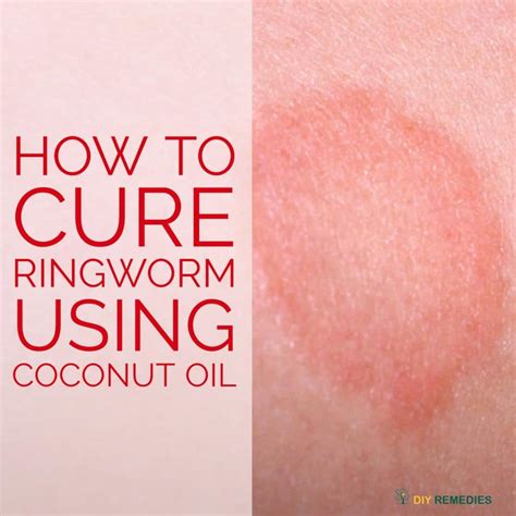 List 98+ Pictures Photos Of Ringworms On Humans Superb