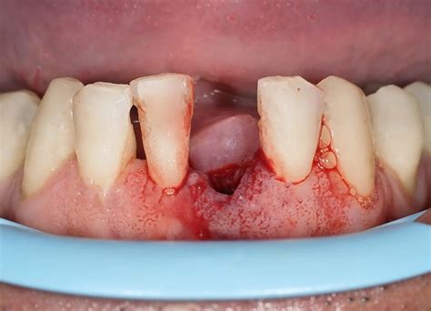 What Does A Blood Clot Look Like After Tooth Extraction