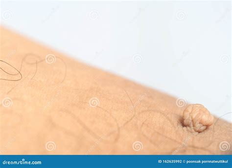 Pedunculated Mass Skin Tag or Acrochondon or Soft Fibroma. Stock Photo - Image of beige ...