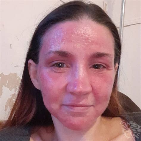 This Woman's Skin Has Been Damaged So Much By Steroid Creams That ...