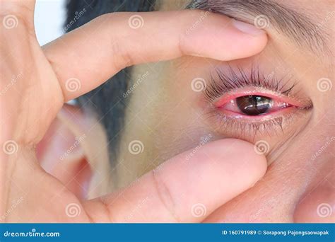 The Young Man Has Red Eye Inflammation,Conjunctiviti. Stock Image - Image of close, astigmatism ...