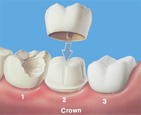 Crowns For Teeth Types at Frank Bullock blog