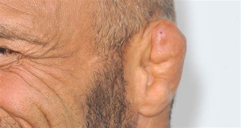 Cauliflower Ear - Symptoms, Causes and Treatment