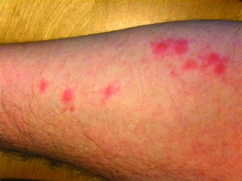 What Do Bed Bug Bites Look Like? | ABC Blog