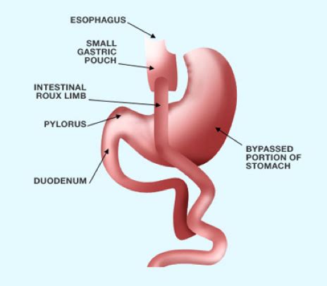 Roux-en-Y Gastric Bypass | 360 Bariatrics: Re-Shaping Bodies & Lives