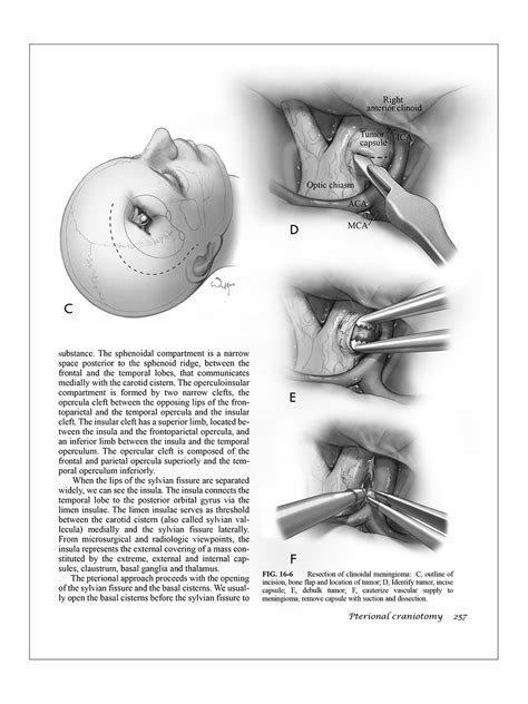 Pteryonal Craniotomy for Clinoidal Meningioma – I-Hsun Wu Biomedical ...