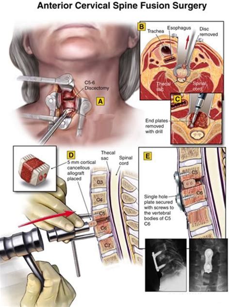 acdf surgery - Google Search (With images) | Neck surgery, Acdf surgery, Spine surgery