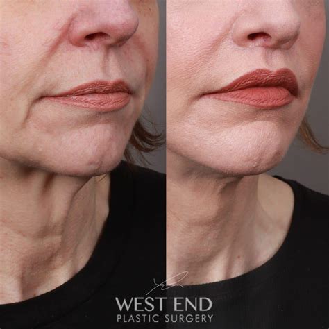 Lip Lift - West End Plastic Surgery