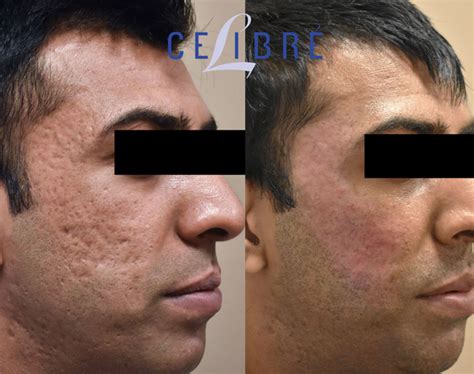 Acne Scar Removal Before and After Pictures of Actual Patients
