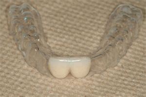 Essix retainer replacing front two upper incisors | Dental retainer ...