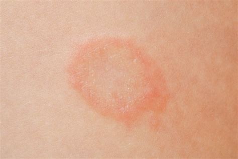 What does ringworm look like? - healblogger - Heal Blogger
