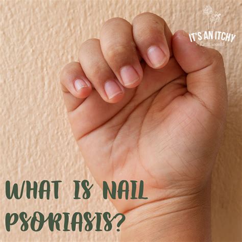 Nail Psoriasis: Causes, Symptoms, and Treatments | itchylittleworld.com