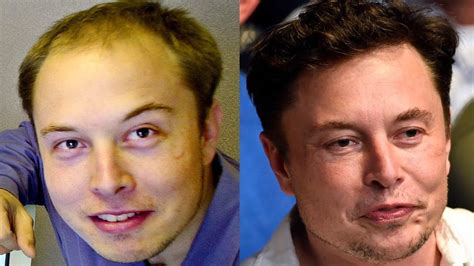Elon Musk’s Rogaine Treatment For Baldness | Justinboey