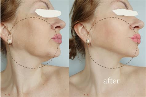 Thread Lift Before and After Jowls: Rejuvenate Your Appearance