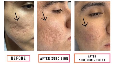 subcision acne scars before and after - Captions Guru