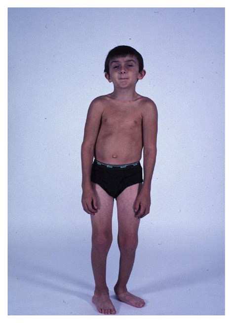 File:Schwartz Jampel syndrome OMIM 255800.jpg - Wikimedia Commons