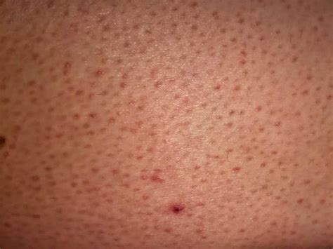 Skin Keratosis Pilaris