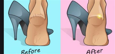 Follow this home remedy to get rid of heel pain | NewsTrack English 1