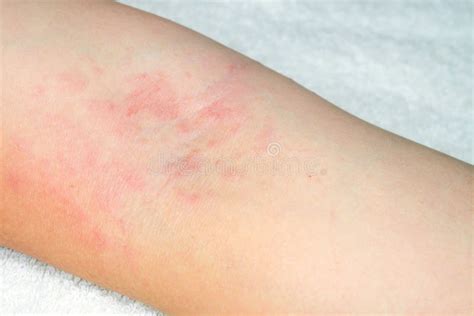 Mold Allergy Skin Rash