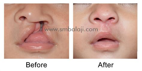 Cleft Lips After Surgery | Lipstutorial.org