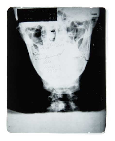 Sold Price: A Muhammad Ali Broken Jaw X-Ray Image From 1973 Ken Norton ...