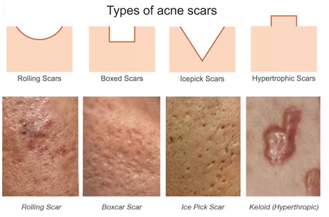 𝕋𝕙𝕖 𝕊𝕜𝕚𝕟𝕗𝕝𝕦𝕖𝕟𝕔𝕖𝕣 on Twitter: "The people have spoken 🙏🏾 A thread on Acne Scarring: -how they are ...
