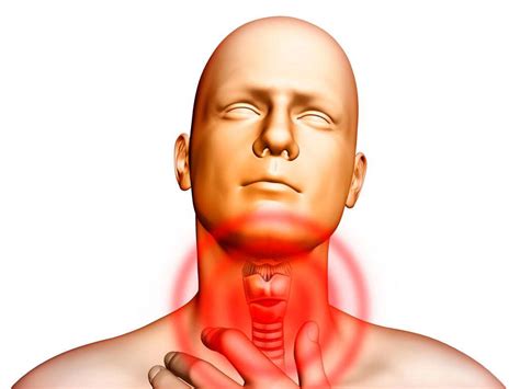 Gastroesophageal Reflux Disease: 10 Gastroesophageal Reflux Disease ...