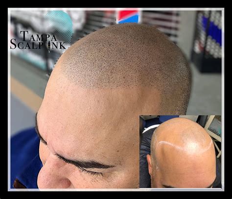 Is Scalp Micro-Pigmentation Painful? | Tampa Scalp Ink