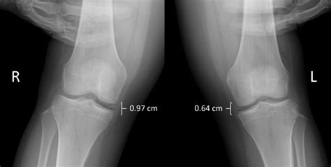 Valgus stress radiograph of the patient's injured knee (R) revealed... | Download Scientific Diagram