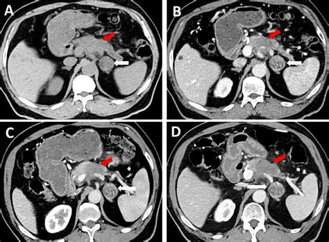Frontiers | An Unexpected Case Report of Adrenal Lymphangioma: Mimicking Metastatic Tumor on ...