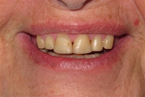 Removable Partial Dentures Smile Gallery - Raber Dental, Kidron Dentist