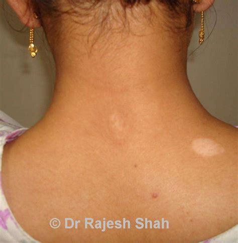 Vitiligo Mild / Vitiligo Skin Disorder Stages: Early, Mild, Focal and Segmental - Introduction ...
