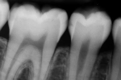 Must-know classifications of Dental Caries for the National Dental Hygiene Boards - StudentRDH Blog