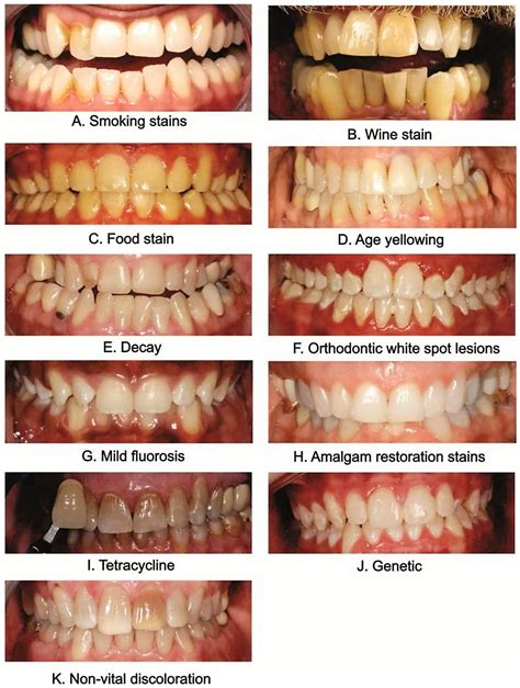 How to Whiten Teeth Naturally - Home Treatment Vs Professional Therapy