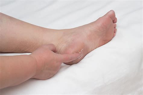 Common Causes Of Heel Spurs And What To Do About Them Mountainview Foot ...