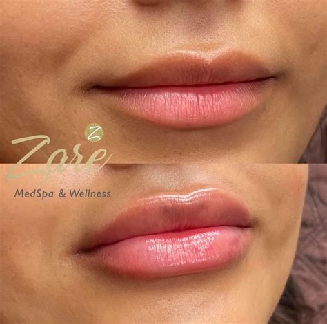 Lip Fillers - Zare Medspa & Wellness