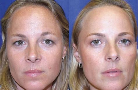 A Botox study on identical twins. | Roberts McCarron Skin Clinic