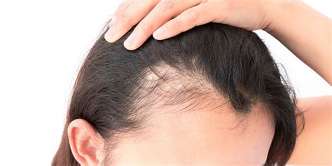 Androgenetic Alopecia Treatment, Cost in Mumbai, India – QR678