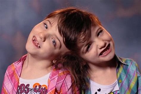 Tatiana and Krista, conjoined twins, inspire everyone with love and determination to live – Late ...