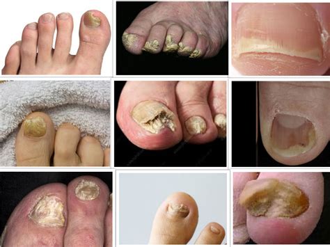 How To Get Rid Of Toe Fungus: Treatment Options And Prevention | Heidi Salon