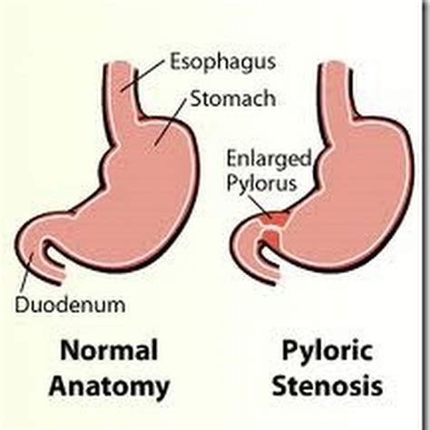 Pyloric Stenosis, Pyloric Obstruction, Stomach Outlet Obstruction ...