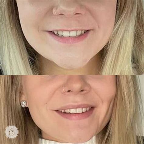 Lip Flip Botox Before And After Photos - Infoupdate.org