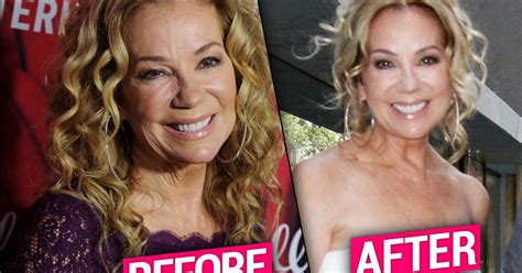 Kathie Lee Gifford Plastic Surgery Makeover Exposed By Top Doctors