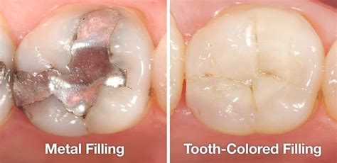 Tooth Colored Fillings | Northwest Dental | Glyndon Maryland