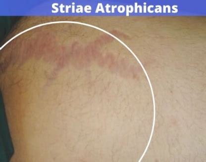 Types of Stretch Marks/ Striae - Phade