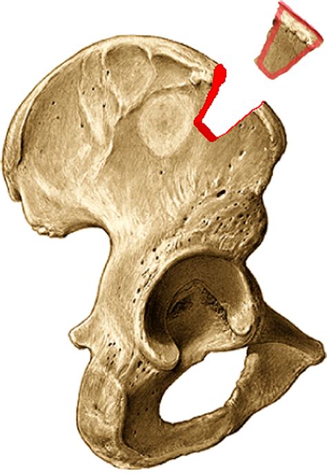 References in Donor site reconstruction in iliac crest tricortical bone graft: Surgical ...