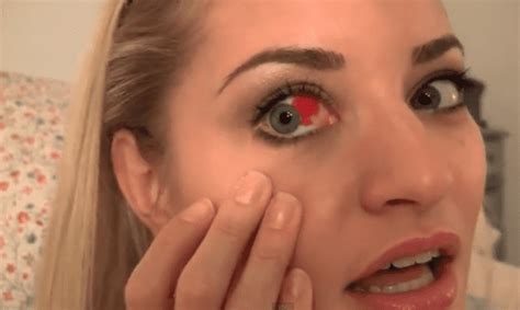 Burst Blood Vessel in Eye: Symptoms, Causes, Treatment - YouMeMindBody